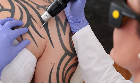 Tattoo%2520Removal_edited_edited.jpg