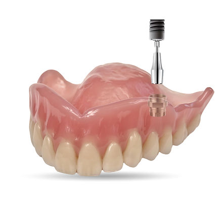 Experience the Atlantis Conus Workflow with AA Dental Design, your Primelab partner.  The Atlantis Conus concept is an advanced, patient specific solution designed to provide the stability of a fixed restoration with the convenience of a removable prosthesis (Overdenture).