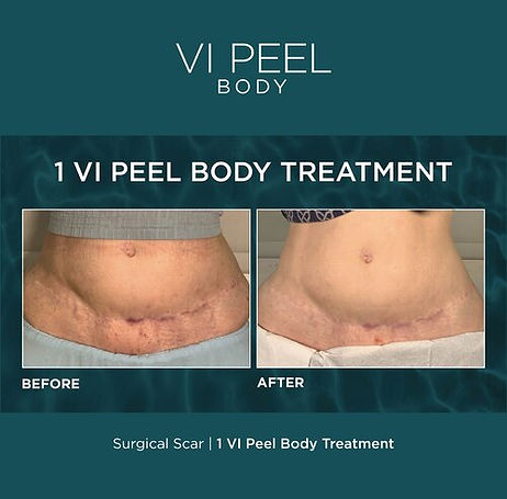 LAVISHiBROWS Winter Garden VI PEEL