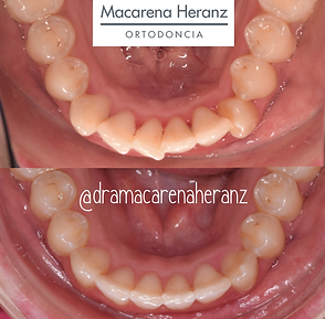 Invisaling Tratamiento de Ortodoncia Invisible