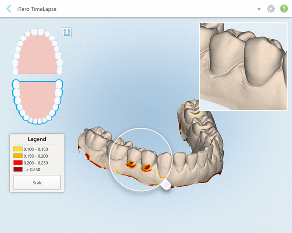Escáner Intraoral iTero Invisaling