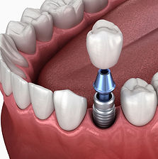 implantes-corona-1b.jpg
