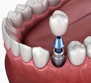 implantes-corona-1b.jpg