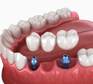 implantes-puente-1b.jpg