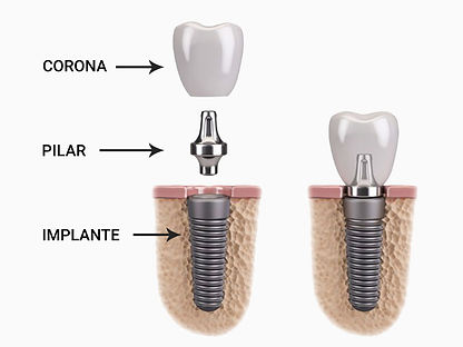 implantes-partes_edited.jpg