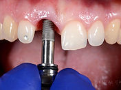causa-rechazo-implantes-fracaso.jpg