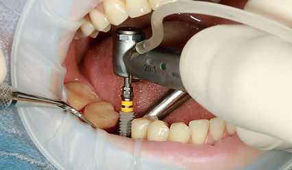 implantes-colocacion-1.jpg