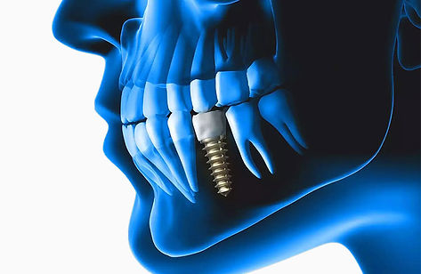 implantes-estudios.jpg
