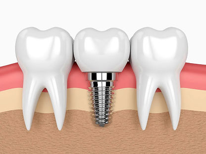 implantes-dentales-2.jpg