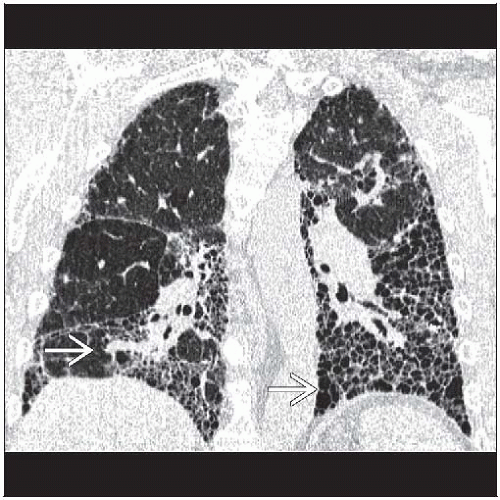 Ipf Radiopaedia Living with Pulmonary Fibrosis