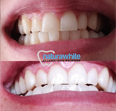 Naturawhite Cosmetic Teeth Whitening Before and After
