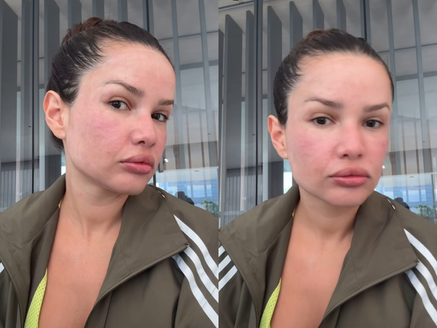 Juliette mostra rosto inchado após procedimento