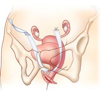 عملية تعليق الاحليل خلف العانة لعلاج السلس البولي TVT retropubic