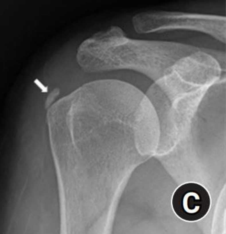 Too Much Calcium in my Tendon? Understanding Calcific Tendonitis