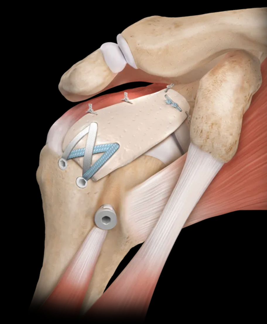 Arthroscopic Management of Irreparable Rotator Cuff Tears: A Patient-Centered Approach