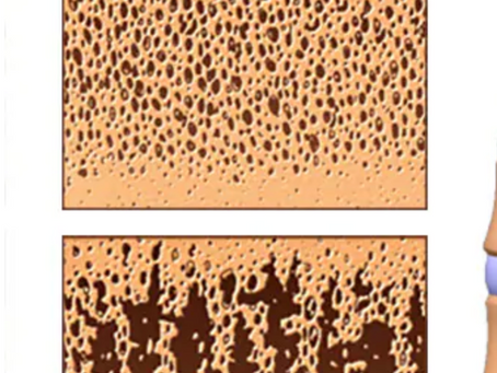 Osteoporosis vs. Osteoarthritis: Understanding the Difference