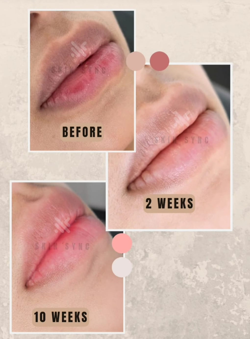 healed before after results from lip blush singapore for dark lips. ghosting phase where pigments disappear.