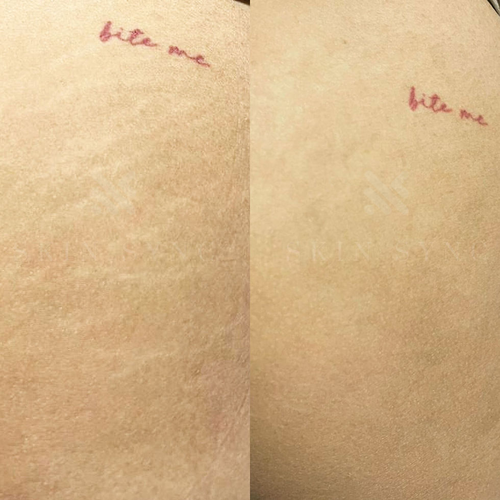skin camouflage to cover dark undereyes in sg under eye. scar camouflage skin coloured tattoo stretchmarks vitiligo post partum stretch marks in sg new mothers