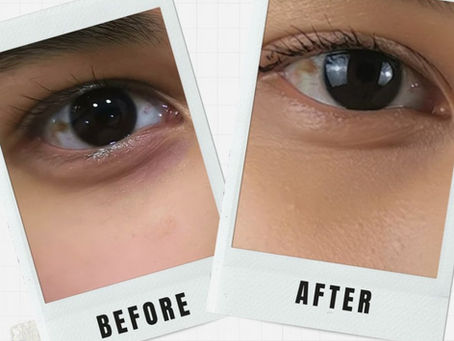 Are Skin Camouflage Tattoos the New Solution for Under Eye Concealers?