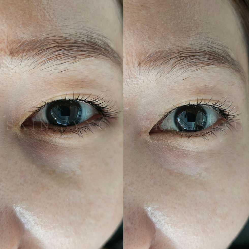 before and after healed results neu tattoo skin camouflage scar camouflage stretch marks camouflage. done at skin sync