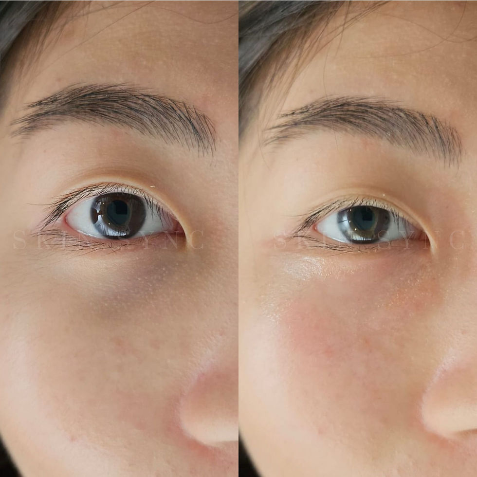 Some redness post treatment is normal which subsides in 12-48hrs