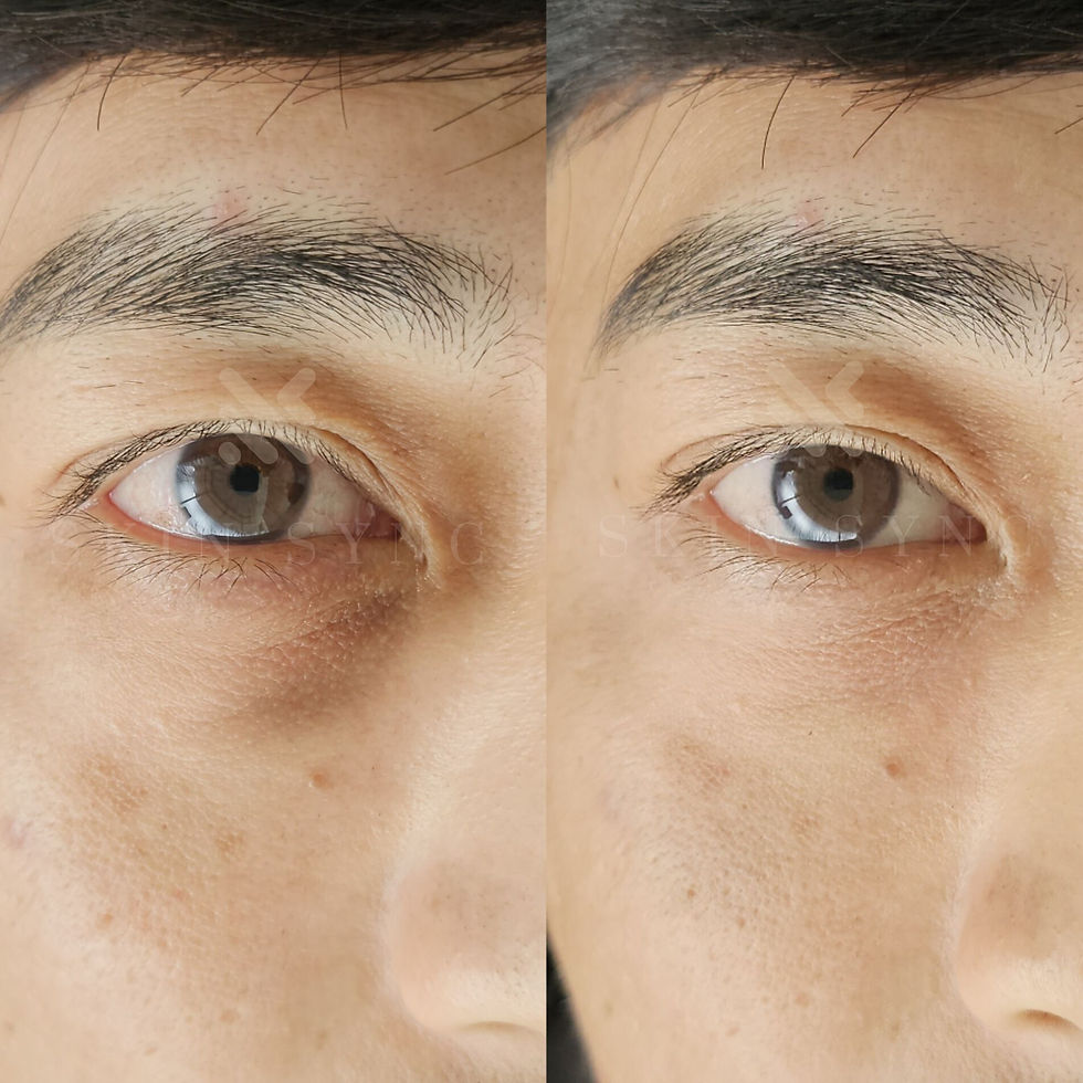 skin camouflage to cover dark undereyes in sg under eye. scar camouflage skin coloured tattoo stretchmarks vitiligo