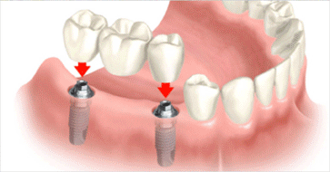 Dental Implants