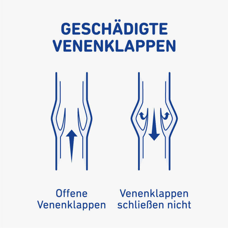 88-bauerfeind-vene-anatomie-geschaedigte-venenklappen.jpg