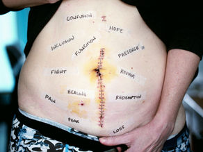 Mental Health: The Overlooked Aspect of Cancer Care