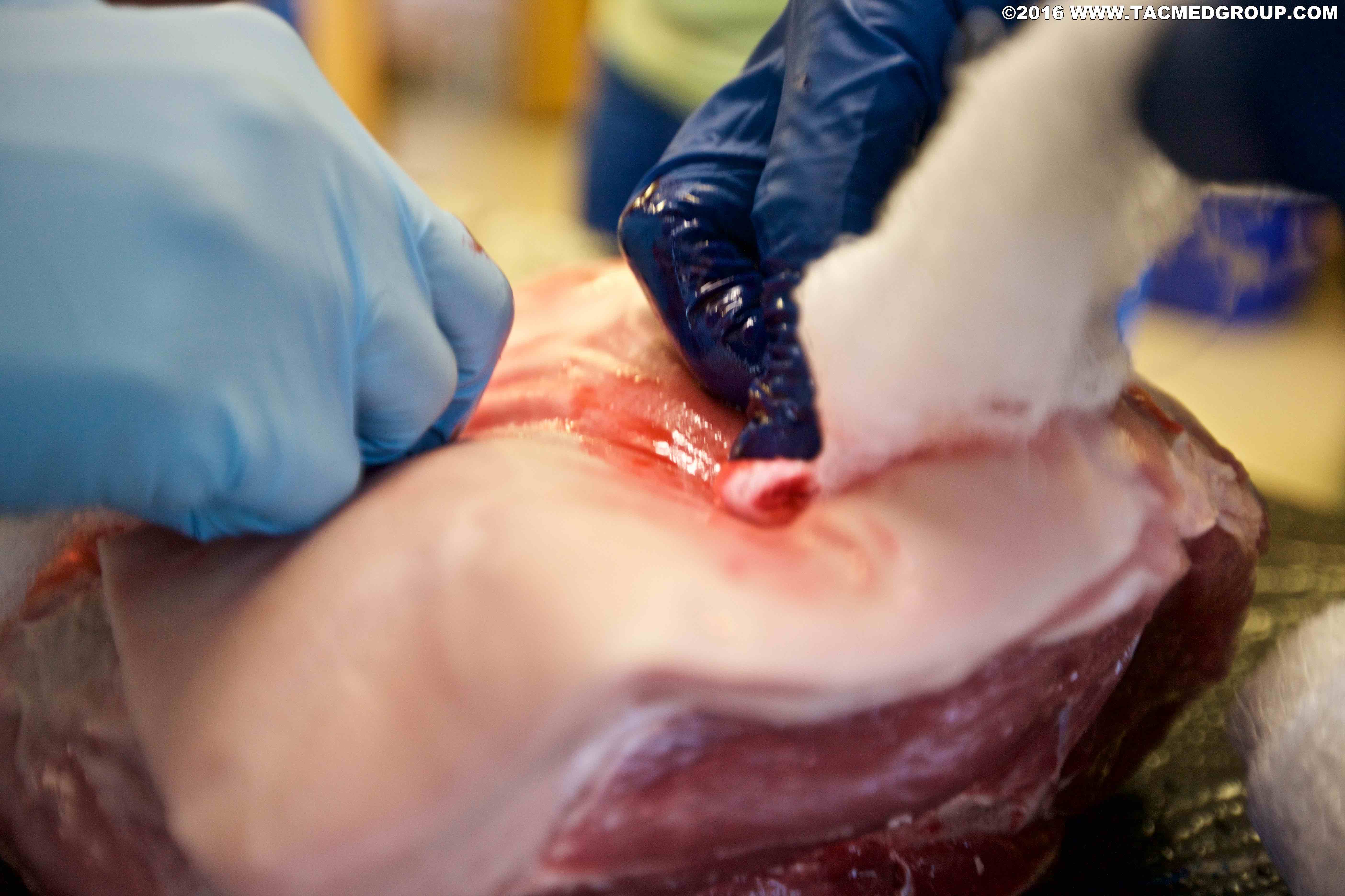 Wound packing
