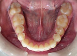 after braces lower arch photo Village Orthodontics