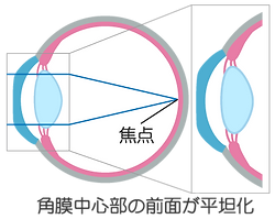 がもう駅前クリニック オルソケラトロジー 装着後