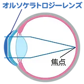 がもう駅前クリニック オルソケラトロジー 装着中