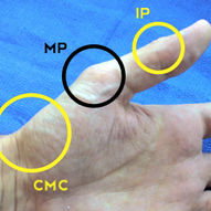 Thumb Splint Rings, which one is right for you?