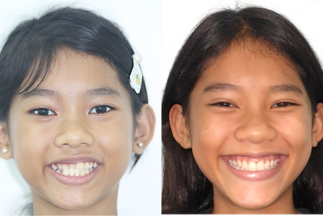 37- Parnell Orthodontics treatments by Dr Adith - specialist orthodontist Auckland Central