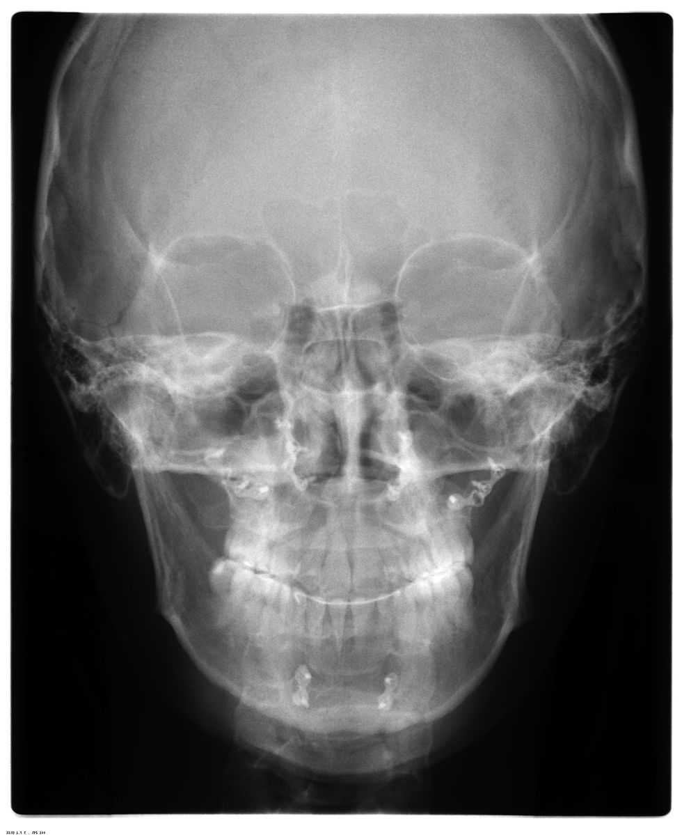 Rx POSTERO ANTERIOR