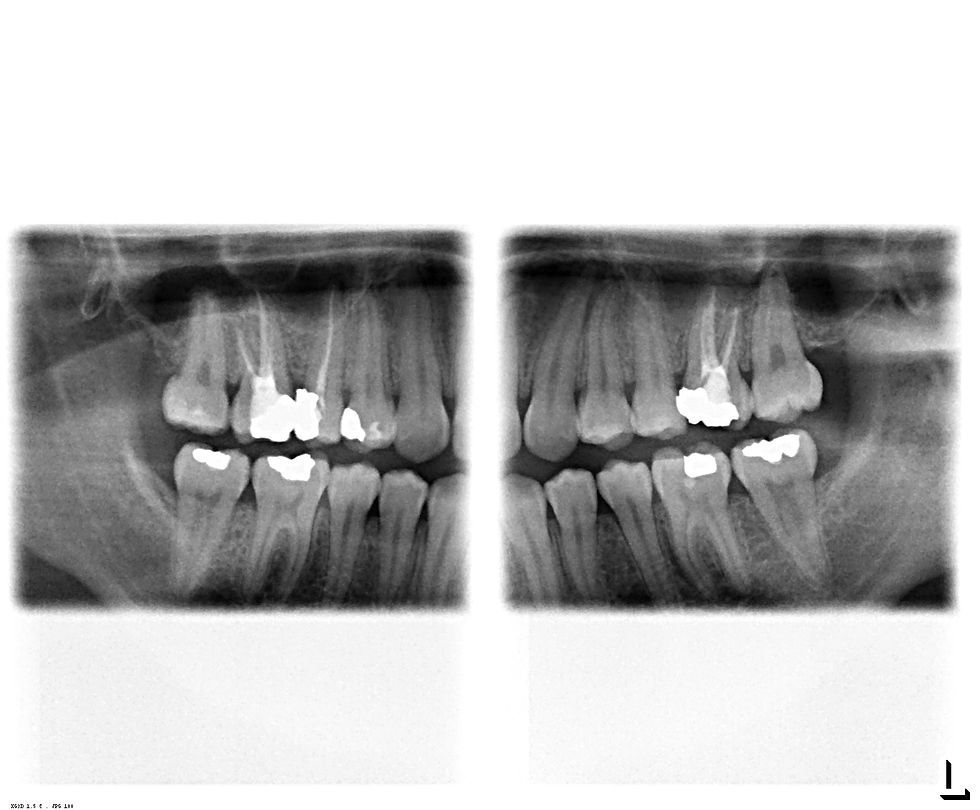 Rx BITEWING POSTERIORES
