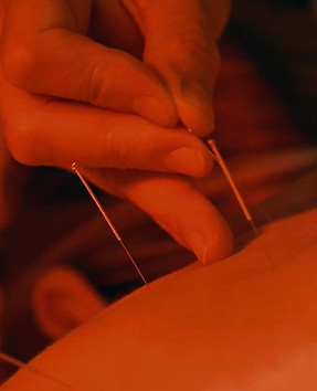 acupuncture pic.jpg
