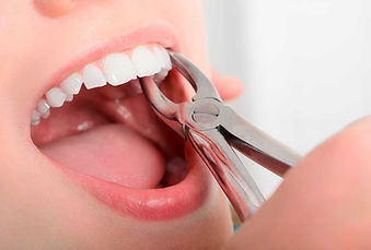 extraccion-dental.jpg