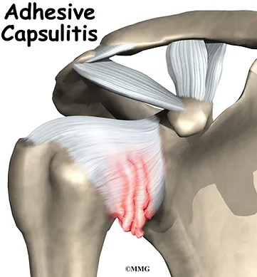 Frozen Shoulder
