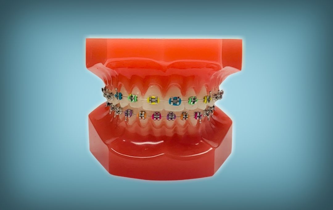 Braces available in Rochster