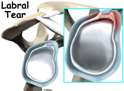 Labral Tear