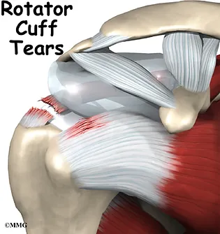 Rotator Cuff Tear