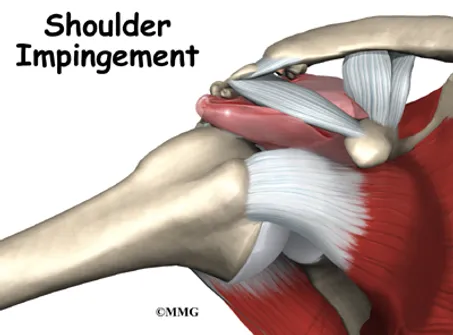 Tendonitis