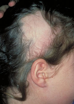Alopecia Areata