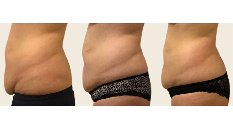ONDA Coolwaves Lokales Fett Hauterschlaffung Behandlung Body Contouring Körperformung Bruck an der Mur