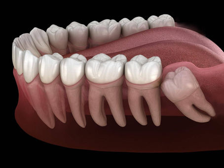 Saying Goodbye to Wisdom Teeth: What to Expect Before, During, and After Removal