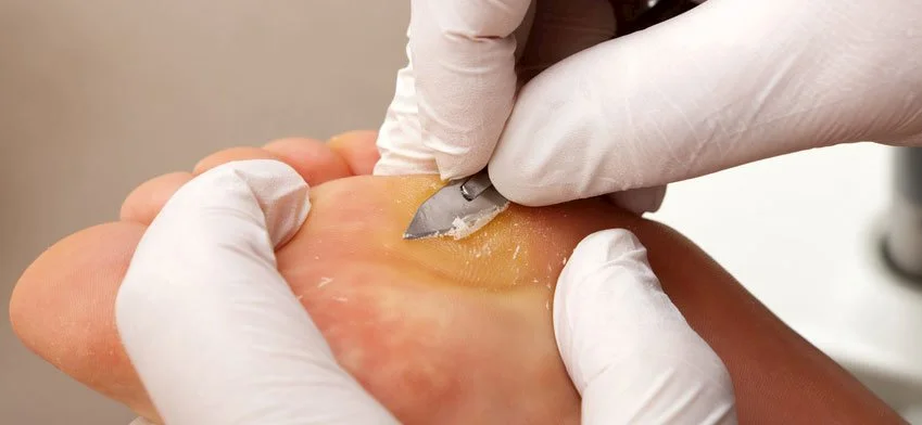 callus-and-corns.jpg (1).webp