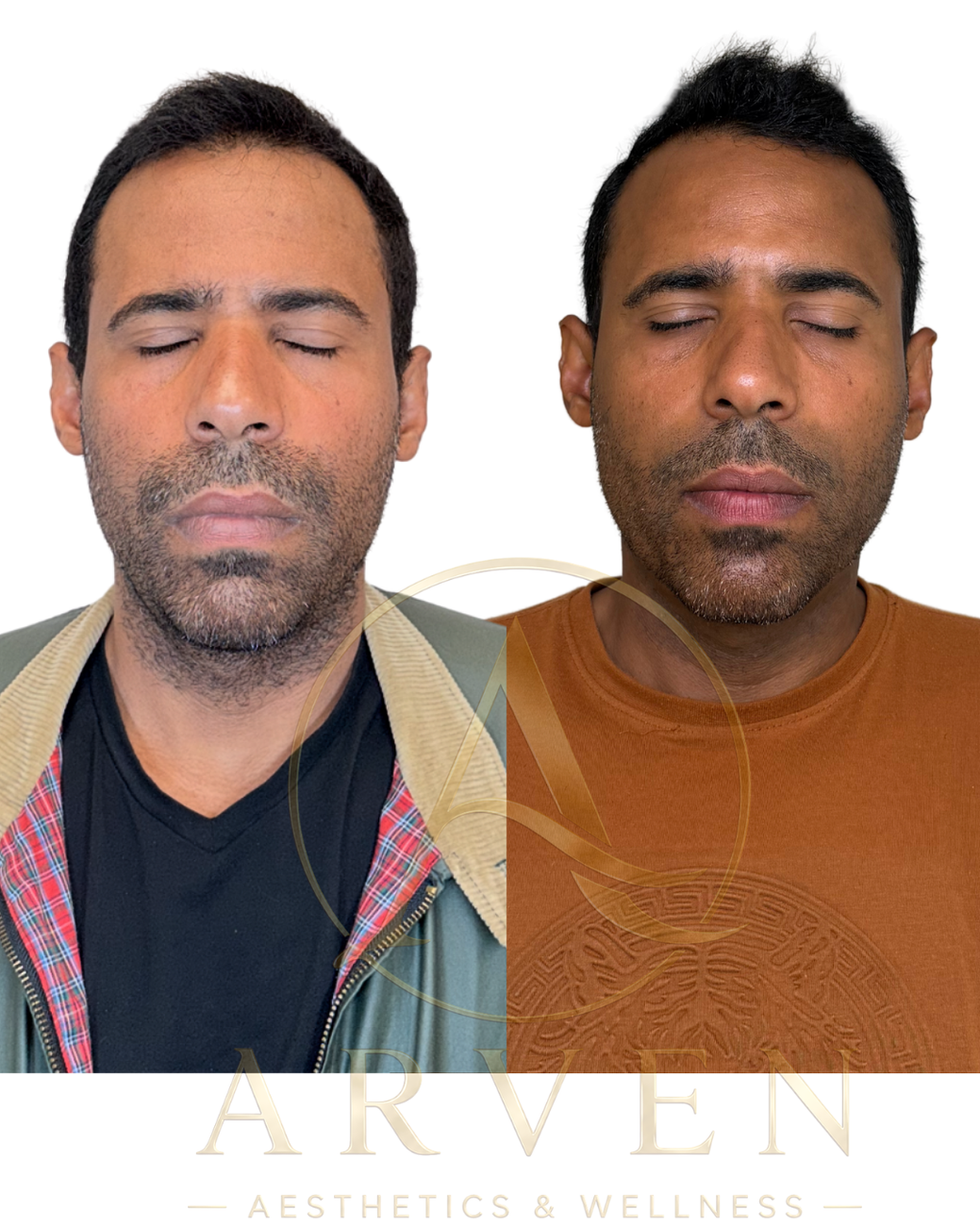 Before and after skin treatment results for a male patient