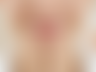 What Is a Lip Flip Botox and How It Compares to Lip Fillers